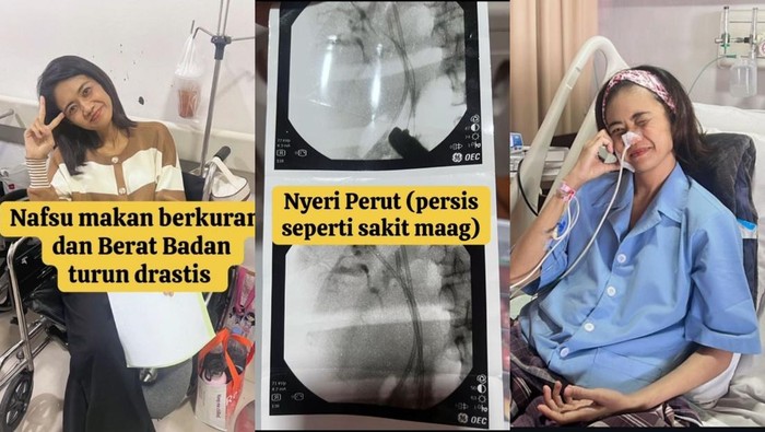 Wanita terkena kanker saluran empedu stadium 4 di usia muda